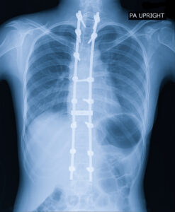 Make the Right Decision About Spine Surgery – The Grid